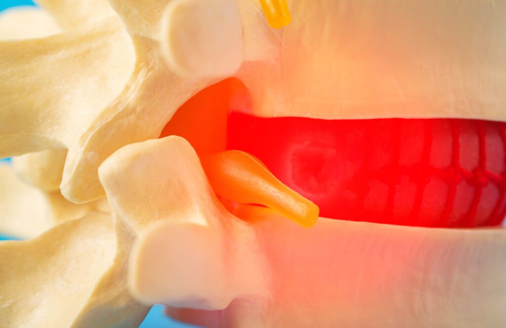Lumbar Medial Branch Blocks - Urban Spine and Joint