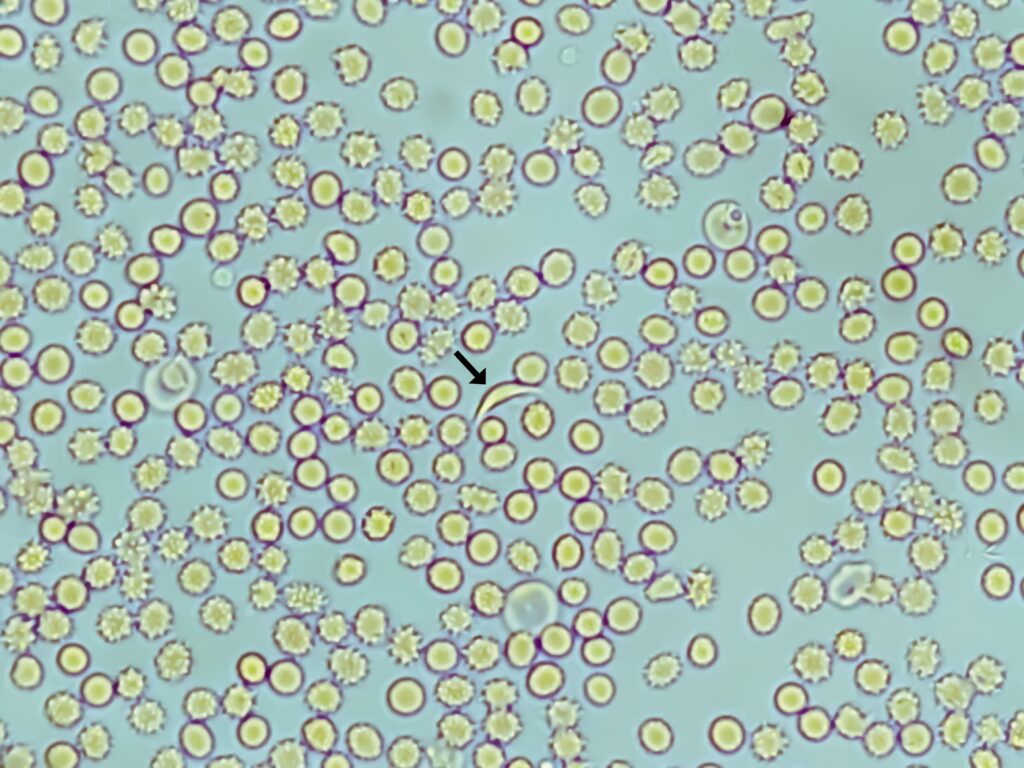 sickle cell