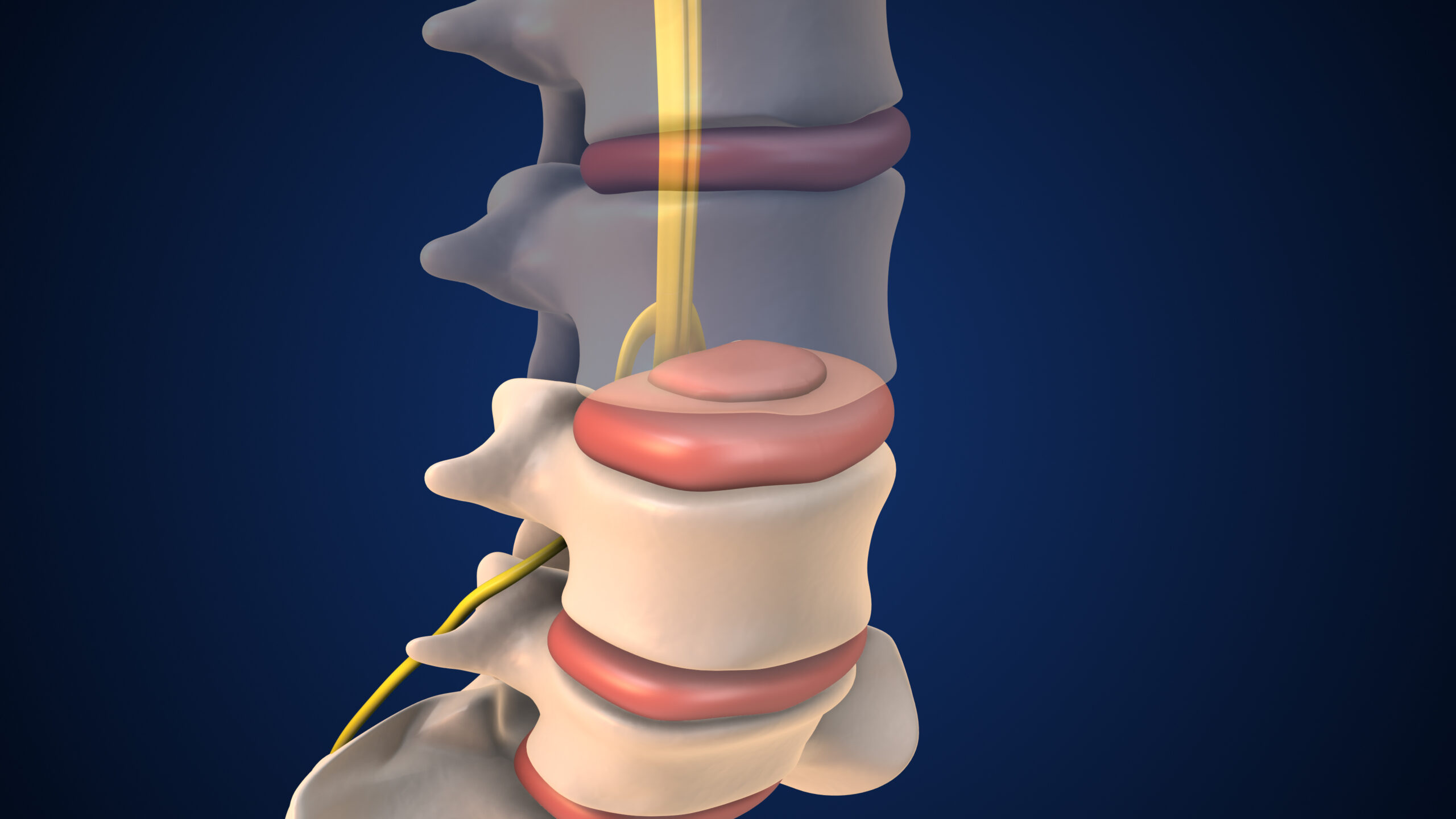 Intradiscal spine treatment options