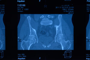Sacroiliac joint