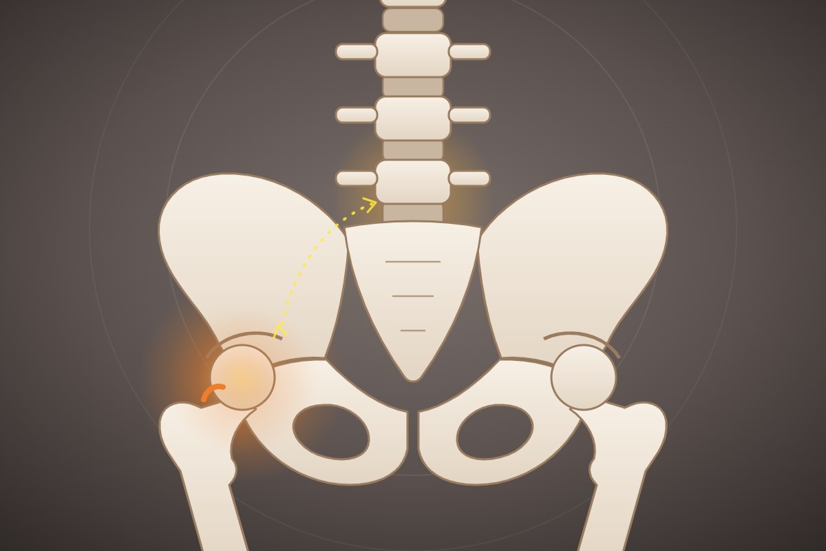 Illustration of the lumbar spine, pelvis, and hip joints with the hip joint highlighted